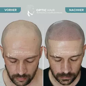 Bild von Haarpigmentierung Köln | OpticHair