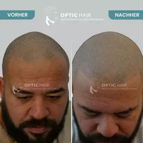 Bild von Haarpigmentierung Köln | OpticHair