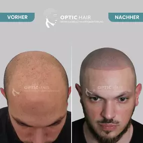 Haarpigmentierung Vorher Nachher Bilder Optic Hair