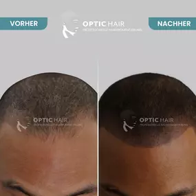 Haarpigmentierung Vorher Nachher Bilder Optic Hair