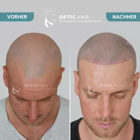 Haarpigmentierung Vorher Nachher Bilder Optic Hair