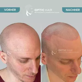 Bild von Haarpigmentierung Köln | OpticHair