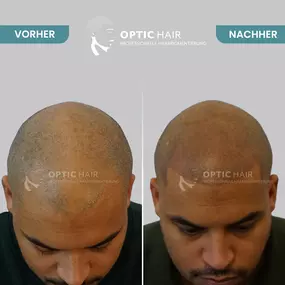 Haarpigmentierung Vorher Nachher Bilder Optic Hair