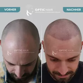 Haarpigmentierung Vorher Nachher Bilder Optic Hair