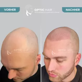 Bild von Haarpigmentierung Köln | OpticHair