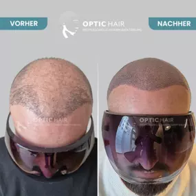 Haarpigmentierung Vorher Nachher Bilder Optic Hair