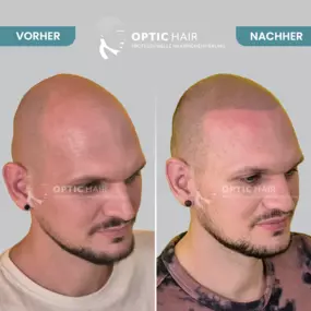 Haarpigmentierung Vorher Nachher Bilder Optic Hair