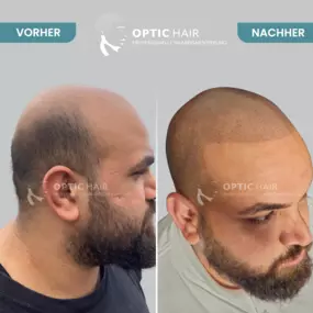 Haarpigmentierung Vorher Nachher Bilder Optic Hair