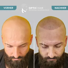 Haarpigmentierung Vorher Nachher Bilder Optic Hair