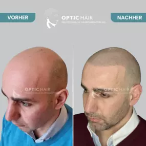 Bild von Haarpigmentierung Köln | OpticHair