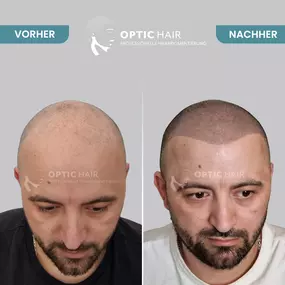 Haarpigmentierung Vorher Nachher Bilder Optic Hair