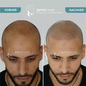 Bild von Haarpigmentierung Köln | OpticHair