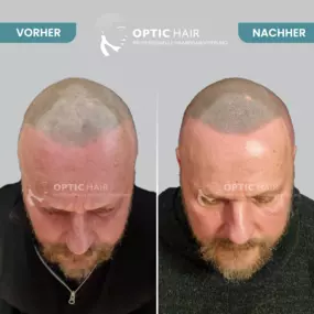 Haarpigmentierung Vorher Nachher Bilder Optic Hair