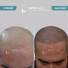 Haarpigmentierung Vorher Nachher Bilder Optic Hair