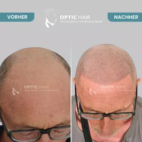 Haarpigmentierung Vorher Nachher Bilder Optic Hair