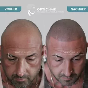 Bild von Haarpigmentierung Köln | OpticHair