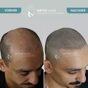 Bild von Haarpigmentierung Köln | OpticHair