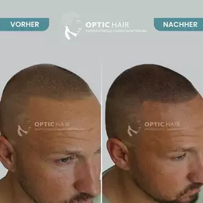 Bild von Haarpigmentierung Köln | OpticHair