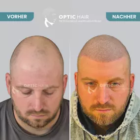 Haarpigmentierung Vorher Nachher Bilder Optic Hair