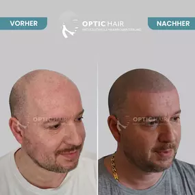 Haarpigmentierung Vorher Nachher Bilder Optic Hair