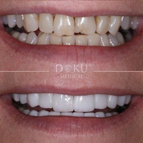 Bild von Veneers & Zahnimplantate – Zähne machen lassen in der Türkei mit Fly2Smile