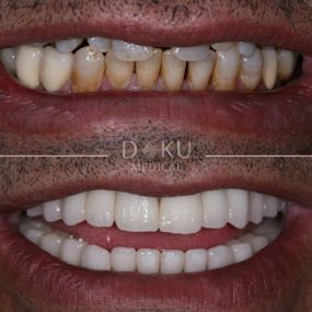 Bild von Veneers & Zahnimplantate – Zähne machen lassen in der Türkei mit Fly2Smile