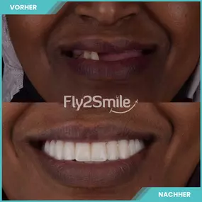 vorher nachher Ergebnis Zahnimplantat - Fly2Smile