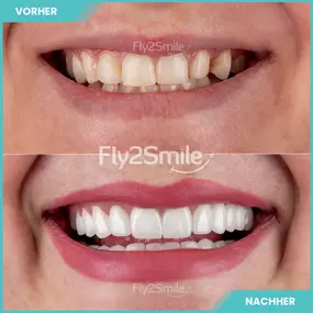 Bild von Veneers & Zahnimplantate – Zähne machen lassen in der Türkei mit Fly2Smile