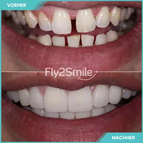 Bild von Veneers & Zahnimplantate – Zähne machen lassen in der Türkei mit Fly2Smile