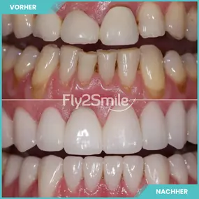 Bild von Veneers & Zahnimplantate – Zähne machen lassen in der Türkei mit Fly2Smile