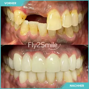 Bild von Veneers & Zahnimplantate – Zähne machen lassen in der Türkei mit Fly2Smile