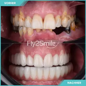 Bild von Veneers & Zahnimplantate – Zähne machen lassen in der Türkei mit Fly2Smile