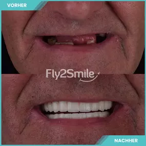 Bild von Veneers & Zahnimplantate – Zähne machen lassen in der Türkei mit Fly2Smile