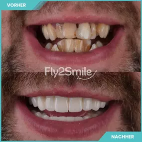 Bild von Veneers & Zahnimplantate – Zähne machen lassen in der Türkei mit Fly2Smile