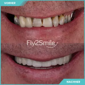 Bild von Veneers & Zahnimplantate – Zähne machen lassen in der Türkei mit Fly2Smile