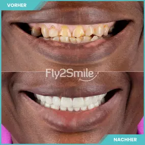 Bild von Veneers & Zahnimplantate – Zähne machen lassen in der Türkei mit Fly2Smile