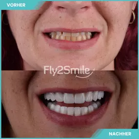 vorher nachher Ergebnis Veneers - Fly2Smile