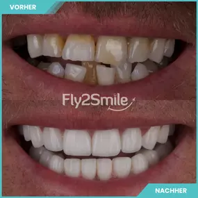 vorher nachher Ergebnis Veneers - Fly2Smile