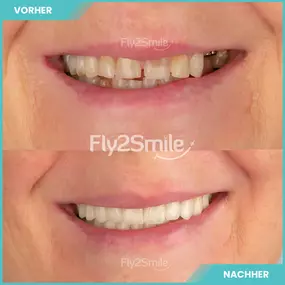 Bild von Veneers & Zahnimplantate – Zähne machen lassen in der Türkei mit Fly2Smile