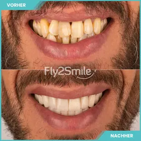 Bild von Veneers & Zahnimplantate – Zähne machen lassen in der Türkei mit Fly2Smile