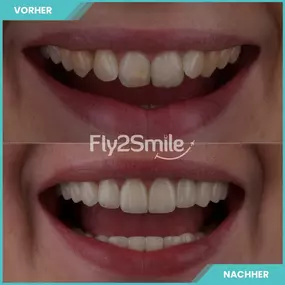 Bild von Veneers & Zahnimplantate – Zähne machen lassen in der Türkei mit Fly2Smile