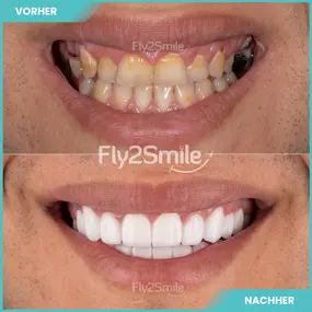 vorher nachher Ergebnis - Fly2Smile