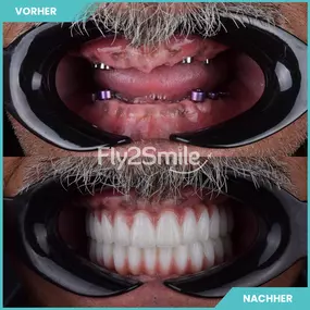 Bild von Veneers & Zahnimplantate – Zähne machen lassen in der Türkei mit Fly2Smile