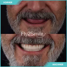 vorher nachher Ergebnis - Fly2Smile