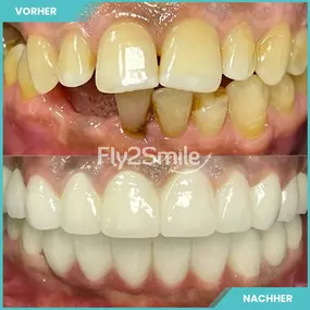 Bild von Veneers & Zahnimplantate – Zähne machen lassen in der Türkei mit Fly2Smile