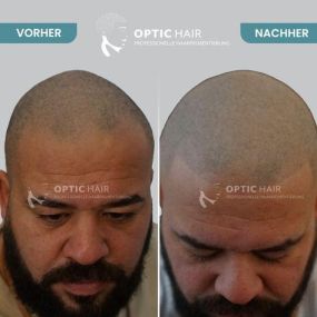 Bild von Haarpigmentierung Berlin | OpticHair