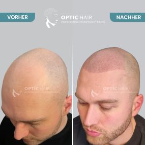 Bild von Haarpigmentierung Berlin | OpticHair