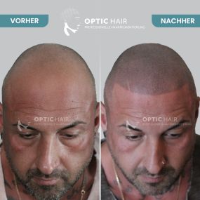 Bild von Haarpigmentierung Berlin | OpticHair