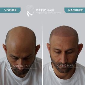 Haarpigmentierung Vorher Nachher Bilder Optic Hair