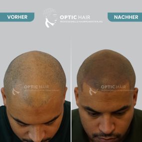 Haarpigmentierung Vorher Nachher Bilder Optic Hair